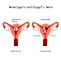 Twins in uterus. Monozygotic and Dizygotic Royalty Free Stock Photo
