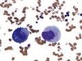 Two atypical megakaryocytes in a case of myelodysplastic syndrome. Royalty Free Stock Photo