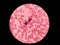 Two blasts in peripheral blood. Blood smear -Hematology.