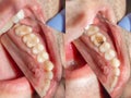 Two chewing side teeth of the upper jaw after treatment of caries. Restoration of the chewing surface with a photopolymer filling