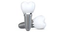 Two dental implant model of molar tooth as a concept of implantation teeth and dental surgery. 3d rendering illustration Royalty Free Stock Photo