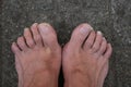 Two feet with hooked toes,on a sidewalk. Concept of small deformation in the lower limbs