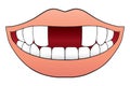 Two Front Teeth Missing Royalty Free Stock Photo