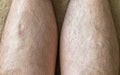 Two large gash wounds healing naturally on the lower leg Royalty Free Stock Photo