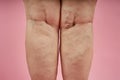 Legs of senior woman with varicose veins on coral background.