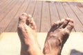 Two male feet exposed to strong sunlight.