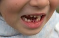 Two milk front teeth were removed from the child . You can see the wounds. Two new indigenous teeth grow at the back Royalty Free Stock Photo