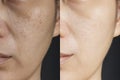 Two pictures compare effect Before and After treatment. skin with problems of freckles , pore , dull skin and wrinkles