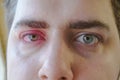 Eyelid abscess