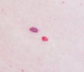 Two red moles on the patient s skin, hemangioma, macro, angioneuromas