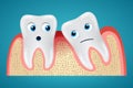 Two tooth and gum hurt Royalty Free Stock Photo