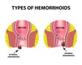 Two types of hemorrhoids are external and internal. Rectum structure. Intestines. colon. Internal and external hemorrhoidal node. Royalty Free Stock Photo