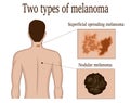 Two types of melanoma Royalty Free Stock Photo