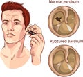 Tympanic membrane