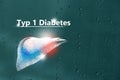 Typ 1 Diabetes, Medizinische Checkliste. Texturierter Hintergrund mit leerer Kopierraum