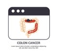 Type of cancer colon vector concept
