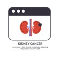 Type of cancer kidney vector concept