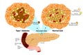 Type 1 diabetes Beta cell destroyed.