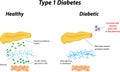 Type 1 Diabetes