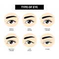 Type of eyelid crease