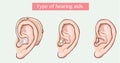 Type of hearing aids