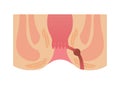 Type of Hemorrhoid flat vector illustration / anal fistula Royalty Free Stock Photo