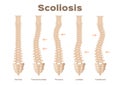 Type, scoliosis medical anatomical / backbone / organ