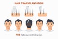 Stages of hair transplantation FUE Unit Extraction