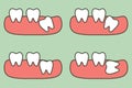 Type of wisdom tooth affect to other teeth Royalty Free Stock Photo