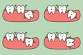 Type of wisdom tooth affect to other teeth