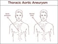 Types of abdominal aortic aneurysm. normal aorta and enlarged vessels. Vector diagram