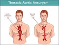 Types of abdominal aortic aneurysm. normal aorta and enlarged vessels. Vector diagram Royalty Free Stock Photo