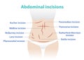 Types of abdominal incision for surgery vector illustration isolated on white background.