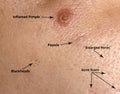 Types of acne and acne on the skin. Enlarged pores, Inflamed pimple, Blackheads, Acne scars, Papule Royalty Free Stock Photo