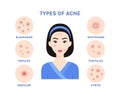 Types of acne. Beautiful Asian Woman with Problem Skin on her Cute Face. Acne treatment. Flat color cartoon style. White