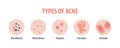 Types of acne diagram illustration vector on white background, B