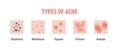 Types of acne diagram illustration vector on white background, B Royalty Free Stock Photo