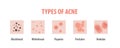 Types of acne diagram illustration vector on white background, B