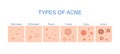 Types of Acne diagram for skin problems content.