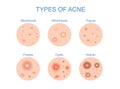 Types of Acne  icon for skin problems content. Royalty Free Stock Photo