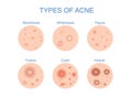 Types of Acne icon for skin problems content.