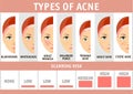 Types of acne infographics. Vector illustration types of acne, pimples, skin pores, blackhead, whitehead, scar