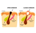 Types of acne. Open comedones, closed comedones, Skin structure. Infographics. Vector illustration on isolated background