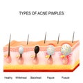 Types of acne pimples Royalty Free Stock Photo