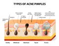 Tipos de acné 
