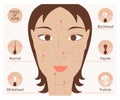 Types of acne and pimples
