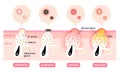 Types of acne illustration. white head,black head, papules, and pustules. Beauty skin care concept