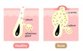 Acne formation process. types of acne. Healthy skin, sebum plug, whitehead, blackhead, Papules, and Pustules.skin care concept