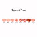 Types of Acne Skin inflammation. Pimples, boils, whitehead, closed comedones, papules, pustules, cystic acne