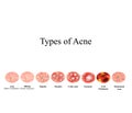 Types of Acne Skin inflammation. Pimples, boils, whitehead, closed comedones, papules, pustules, cystic acne Royalty Free Stock Photo